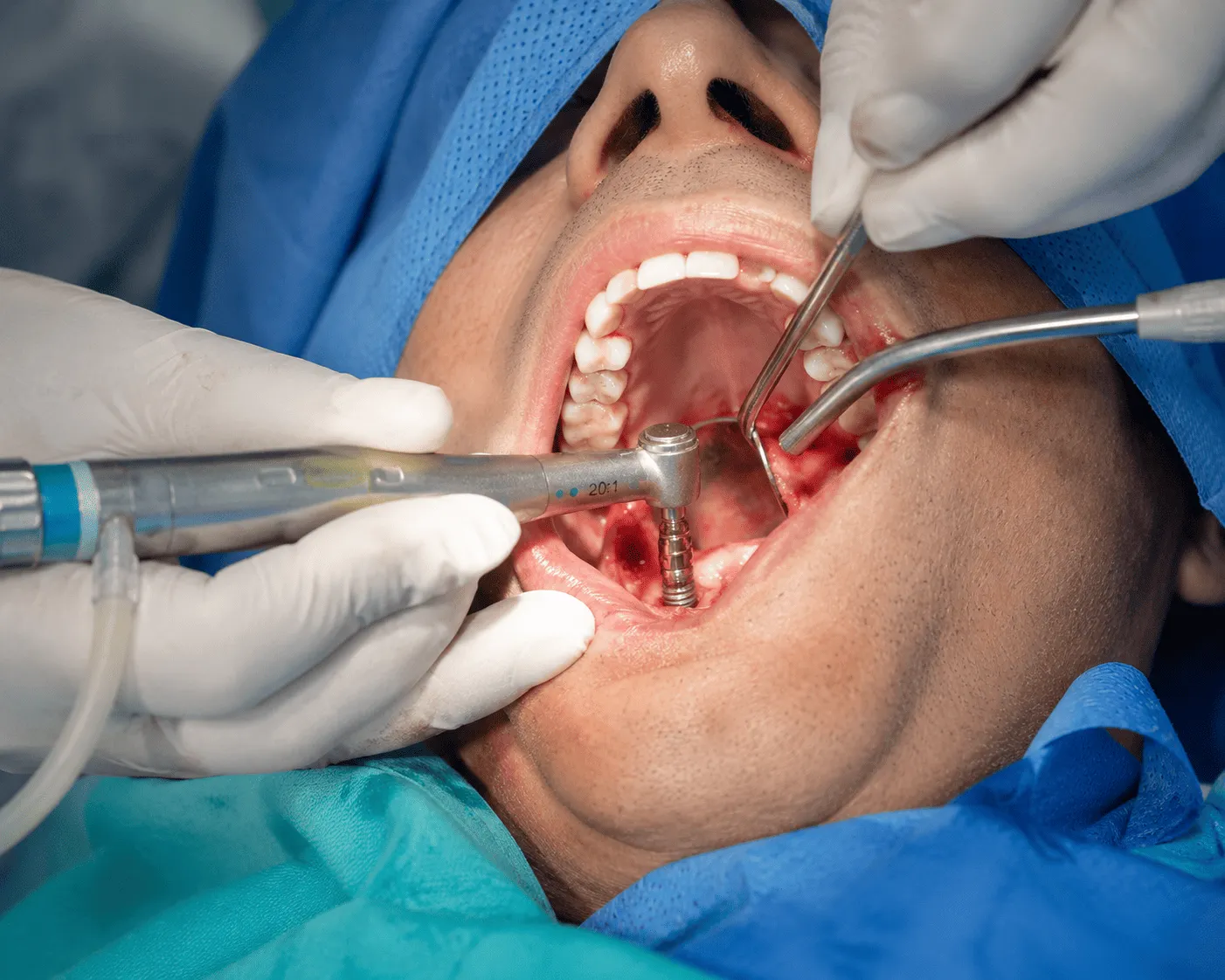 Oral Surgical Procedures